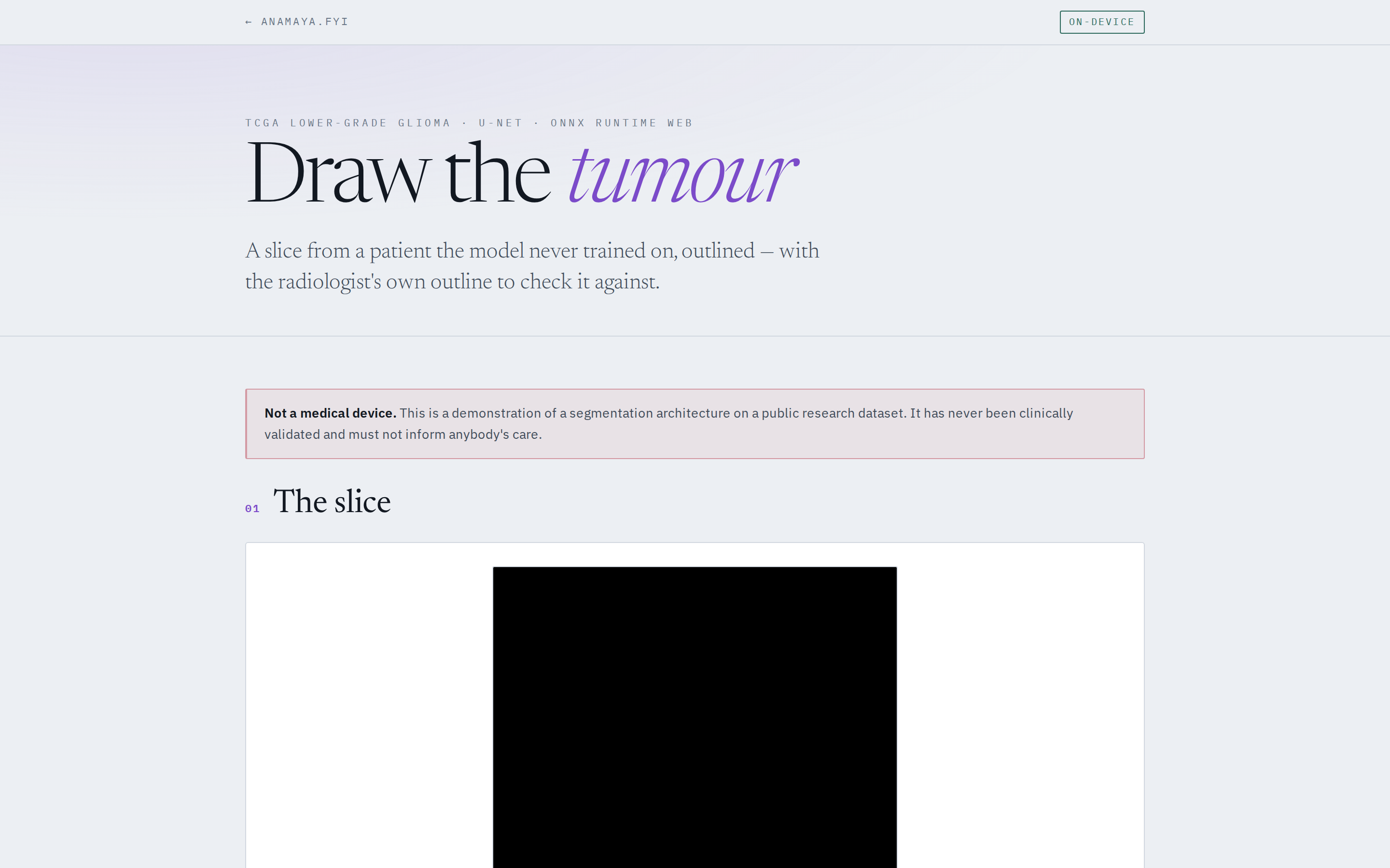 Tumour Segmentation on screen